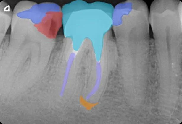 DentalXR.AI segmentation overlay on a periapical radiograph