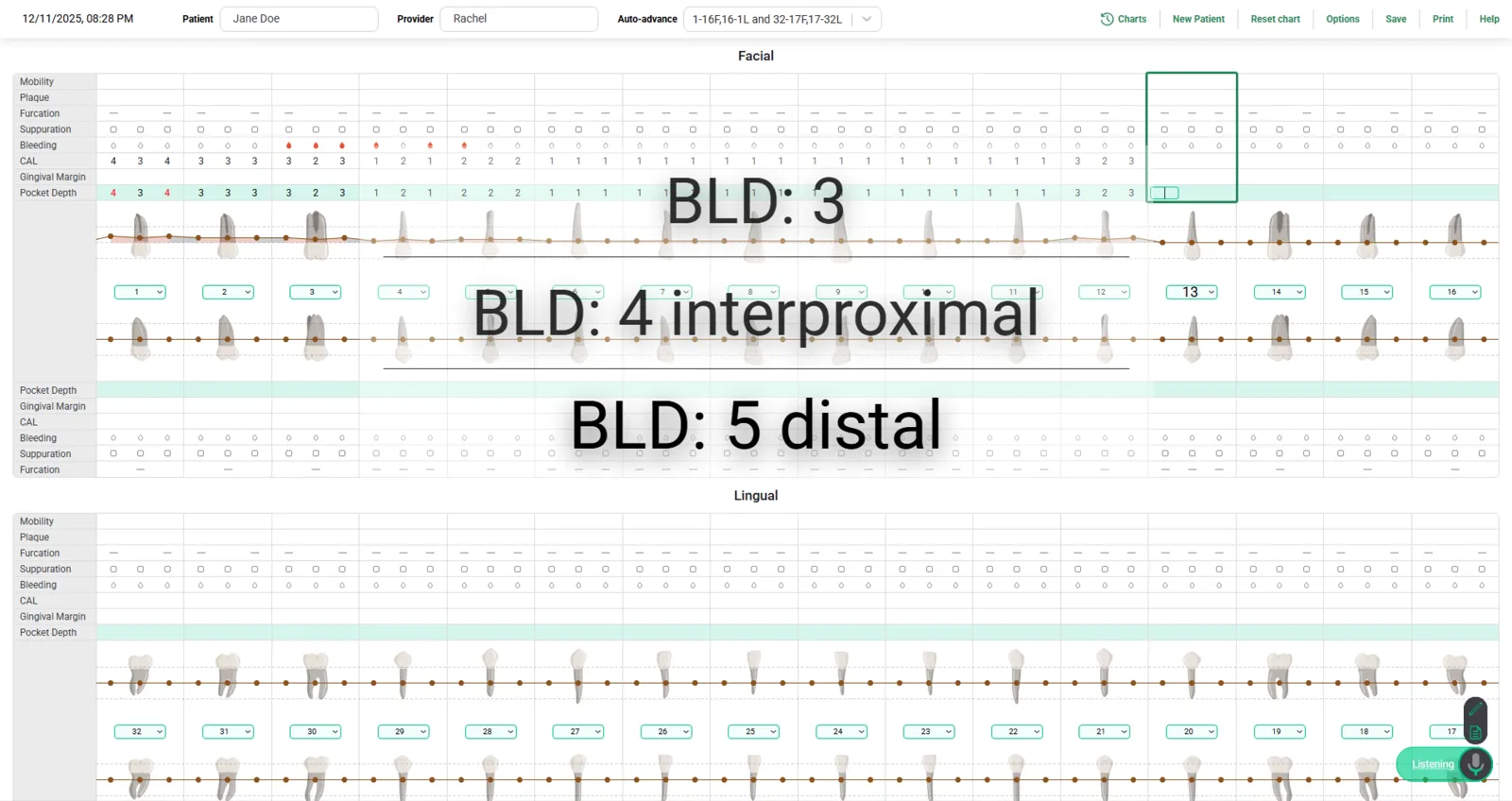 Denti.AI Voice Perio chart with bone-level readings