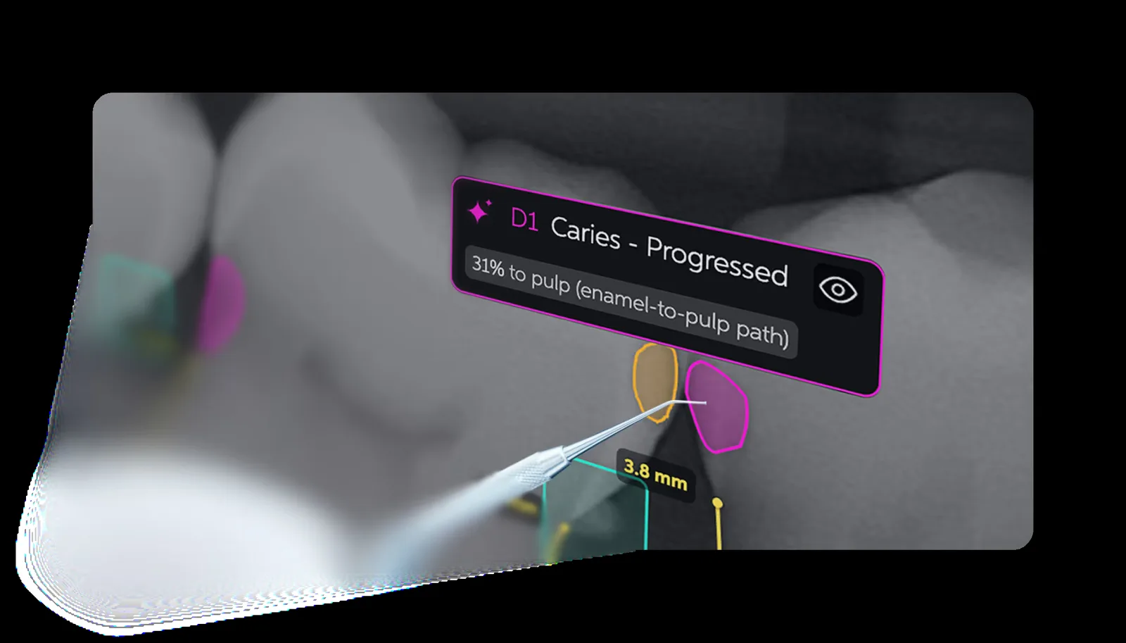 Pearl Second Opinion marking a progressed caries lesion with depth to pulp